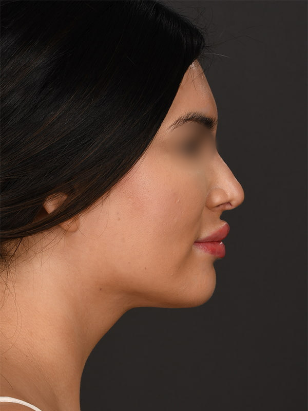 MyEllevate Before & After Image