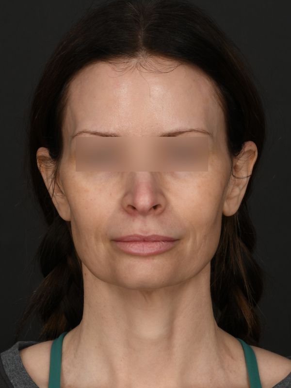 Myellevate Before & After Image