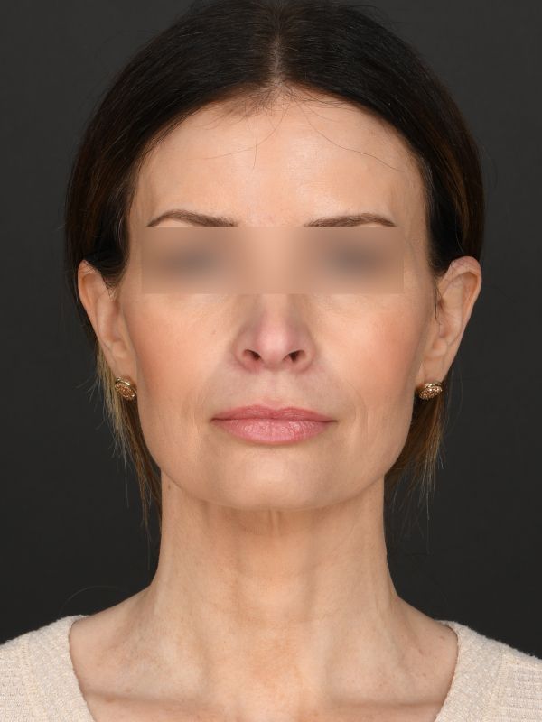 Myellevate Before & After Image