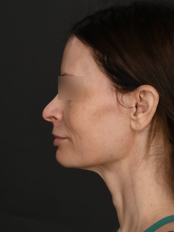 Myellevate Before & After Image