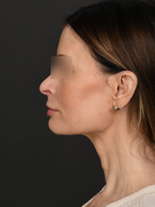 Myellevate Before & After Image