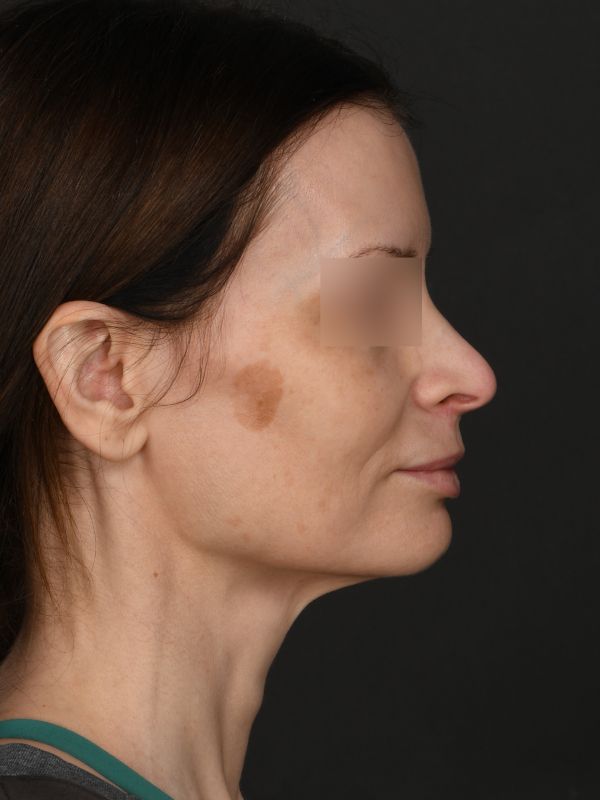 MyEllevate Before & After Image