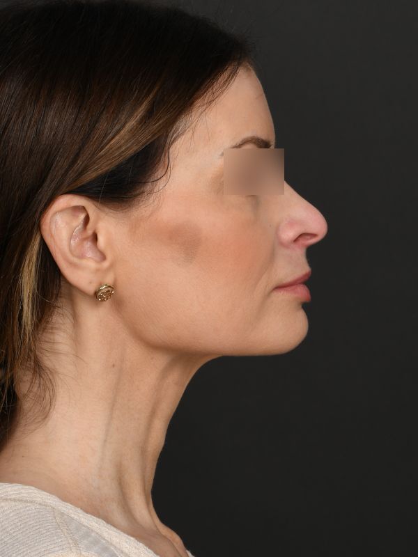 MyEllevate Before & After Image