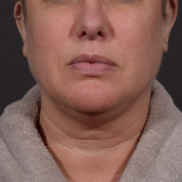 Neck Lift Before & After Image