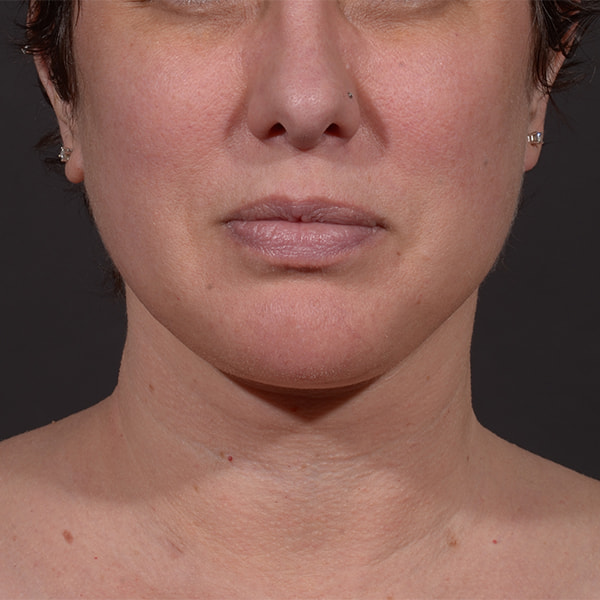 Neck Lift Before & After Image