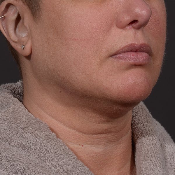 Neck Lift Before & After Image