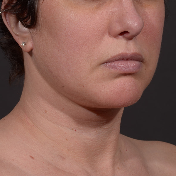 Neck Lift Before & After Image