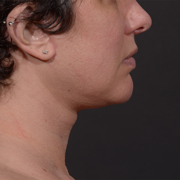 Neck Lift Before & After Image