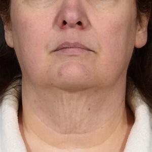 Neck Lift Before & After Image