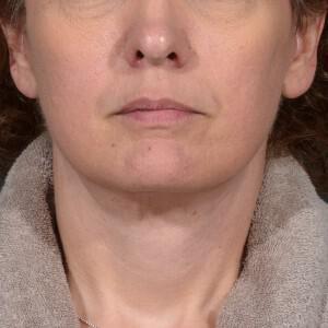 Neck Lift Before & After Image