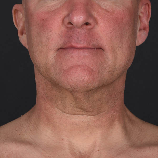 Neck Lift Before & After Image