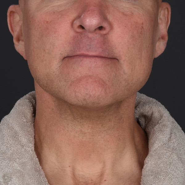 Neck Lift Before & After Image