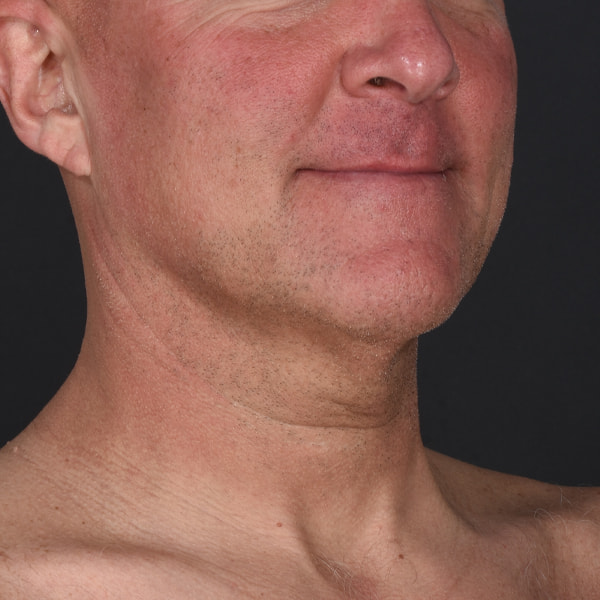 Neck Lift Before & After Image