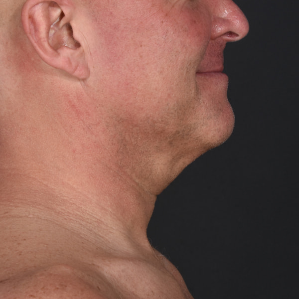 Neck Lift Before & After Image