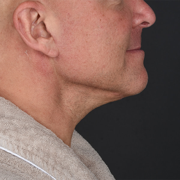 Neck Lift Before & After Image