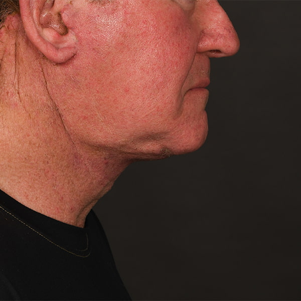 Neck Lift Before & After Image