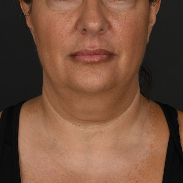 Neck Lift Before & After Image