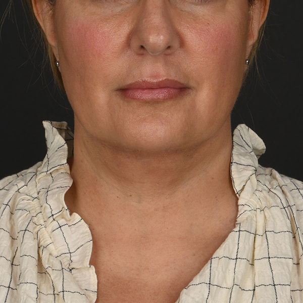 Neck Lift Before & After Image