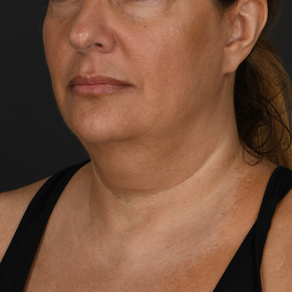 Neck Lift Before & After Image