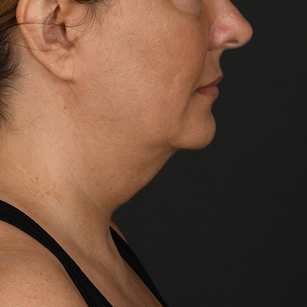 Neck Lift Before & After Image