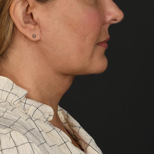 Neck Lift Before & After Image