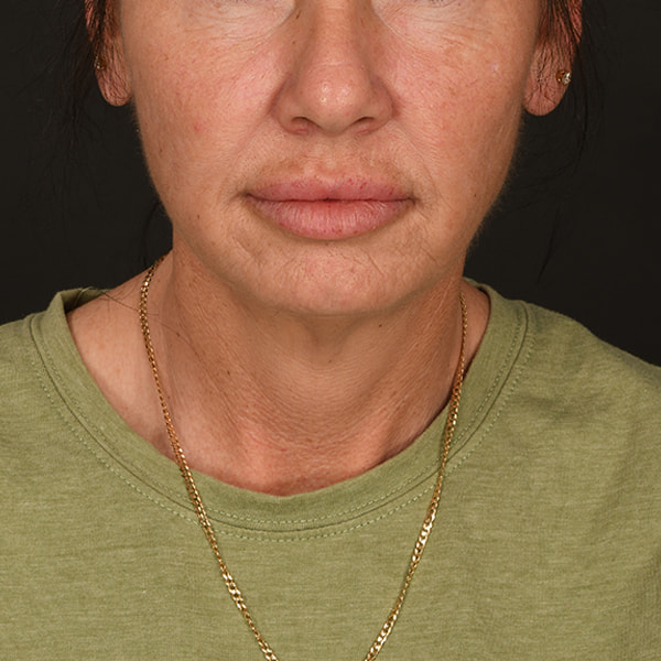 Neck Lift Before & After Image