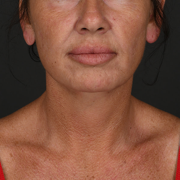 Neck Lift Before & After Image
