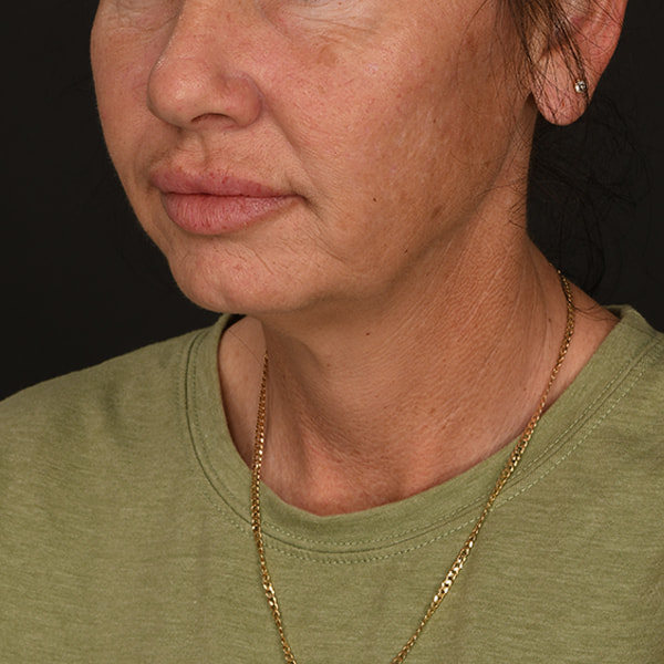 Neck Lift Before & After Image