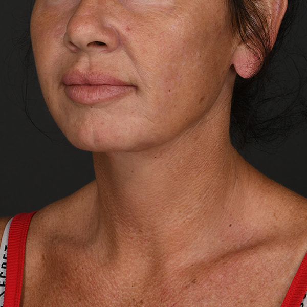 Neck Lift Before & After Image