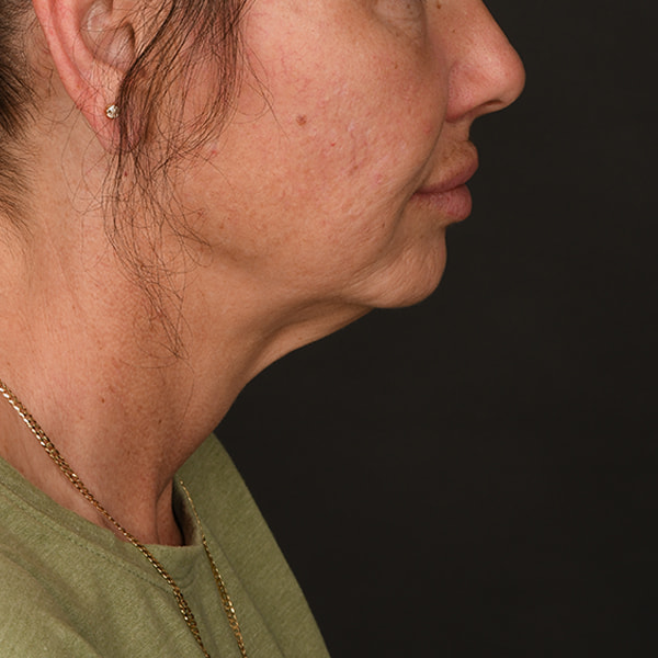 Neck Lift Before & After Image
