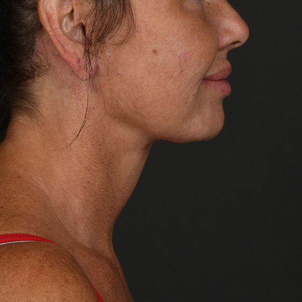 Neck Lift Before & After Image