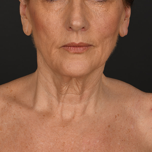 Neck Lift Before & After Image
