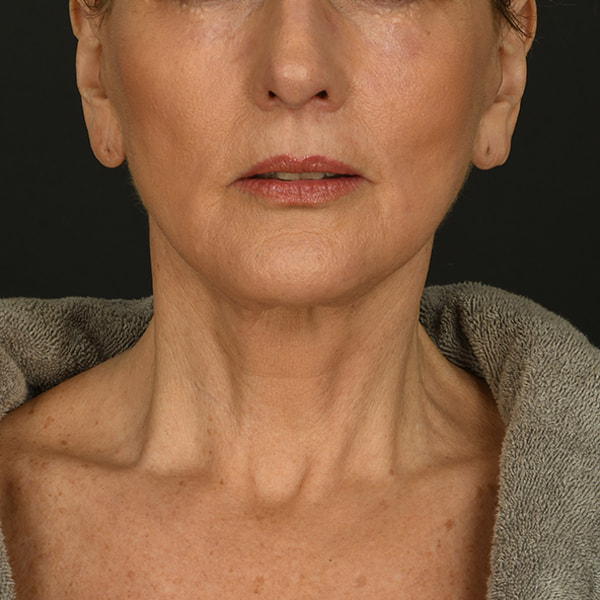 Neck Lift Before & After Image