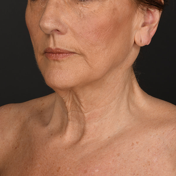 Neck Lift Before & After Image