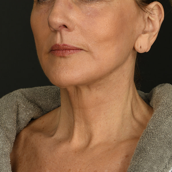 Neck Lift Before & After Image