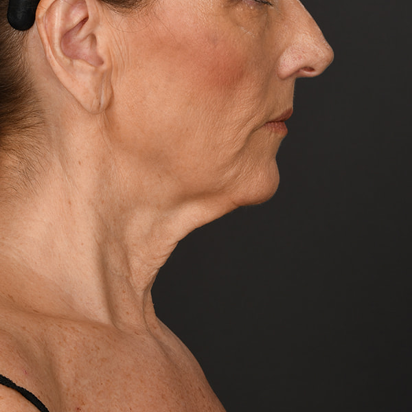 Neck Lift Before & After Image