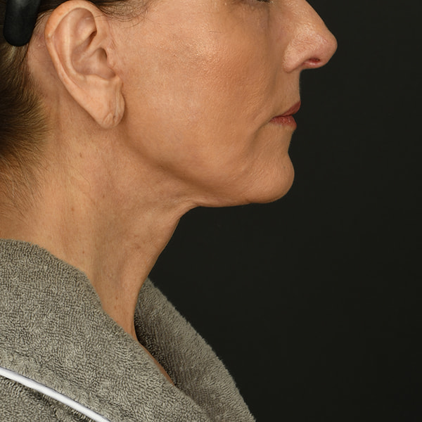 Neck Lift Before & After Image