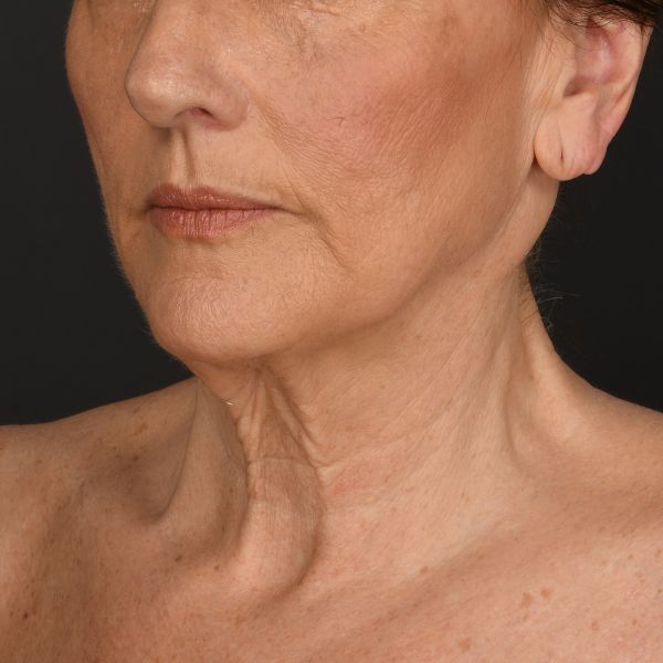 Neck Lift Before & After Image