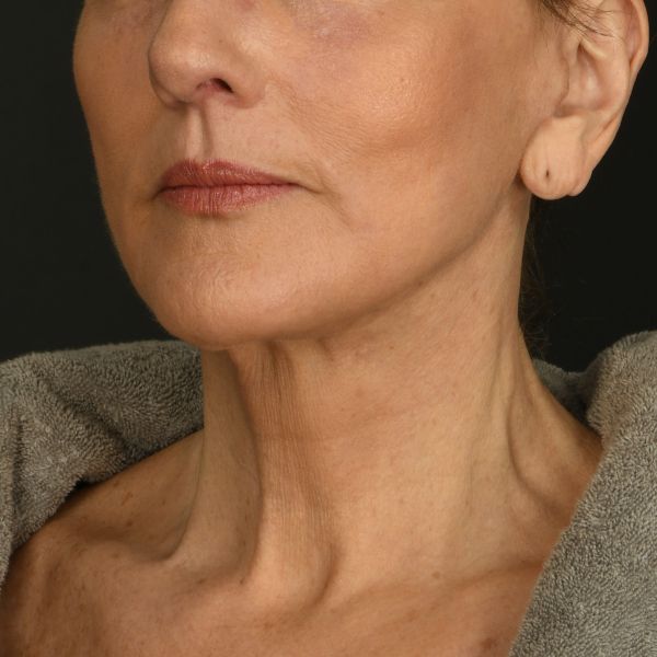 Neck Lift Before & After Image