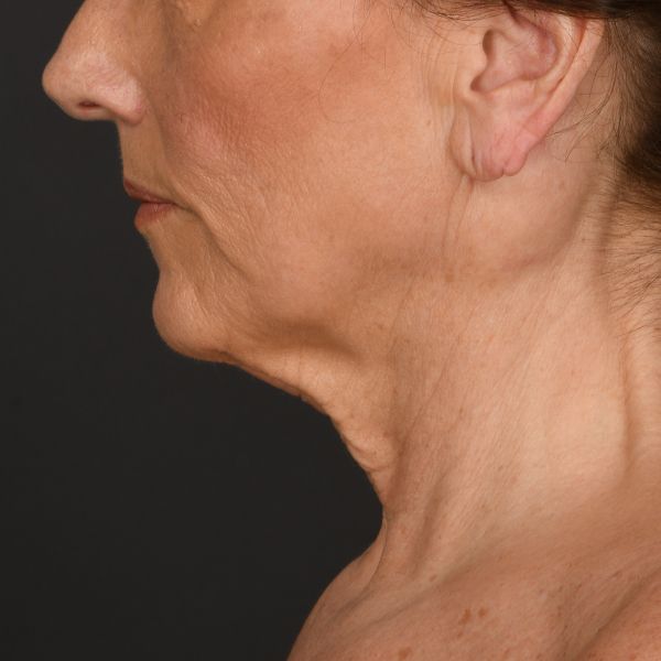 Neck Lift Before & After Image
