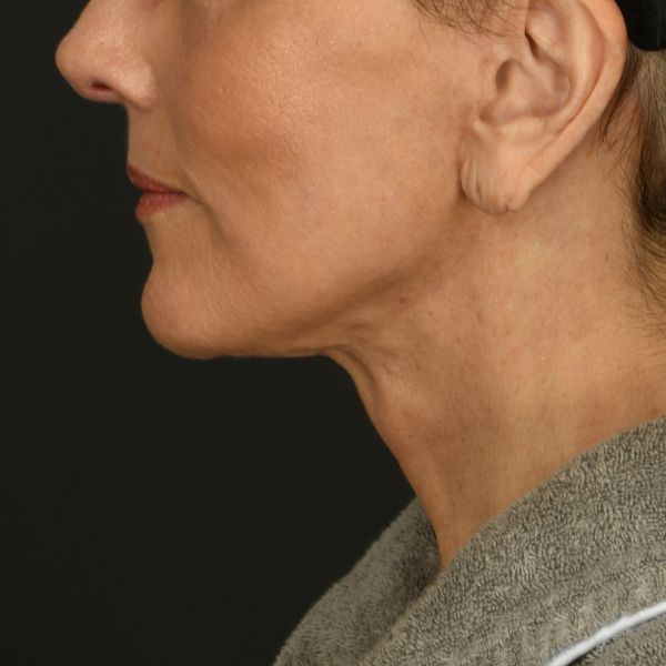 Neck Lift Before & After Image
