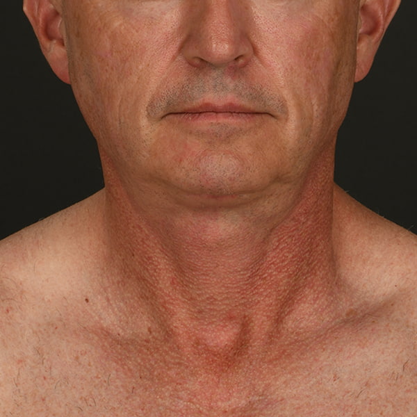 Neck Lift Before & After Image
