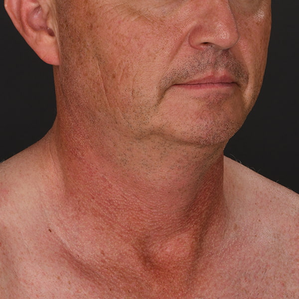 Neck Lift Before & After Image