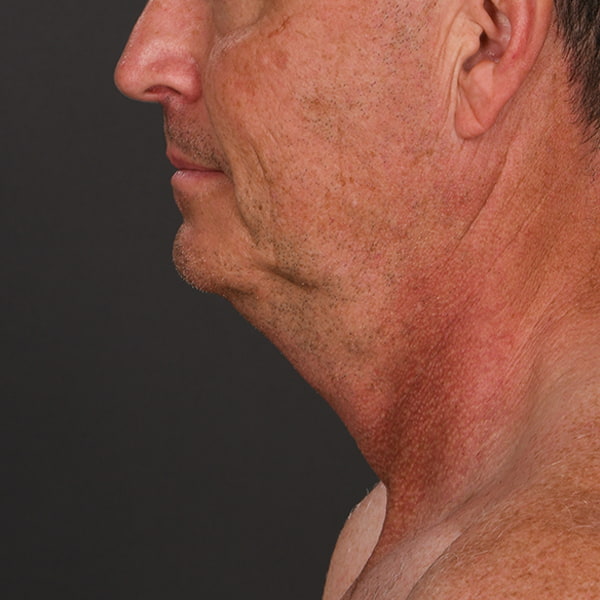 Neck Lift Before & After Image