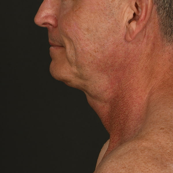 Neck Lift Before & After Image