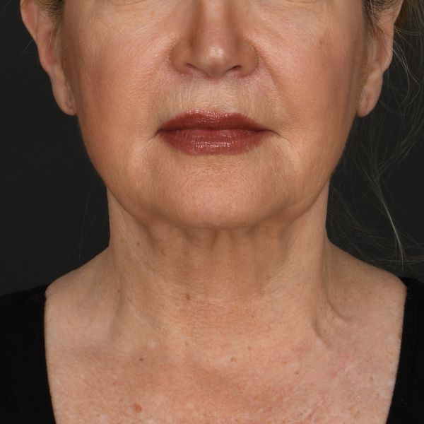 Neck lift Before & After Image