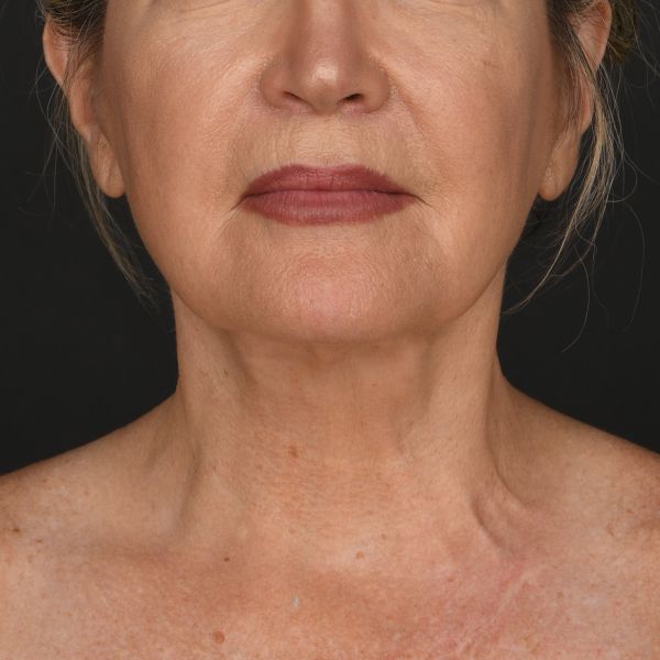 Neck lift Before & After Image