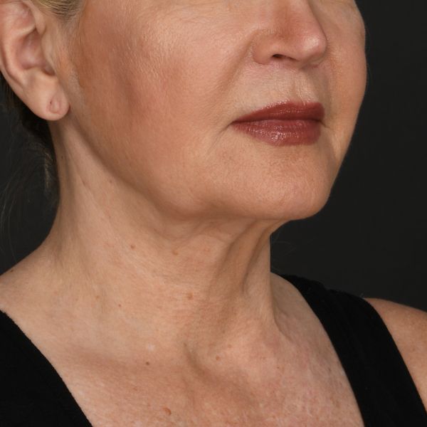 Neck lift Before & After Image
