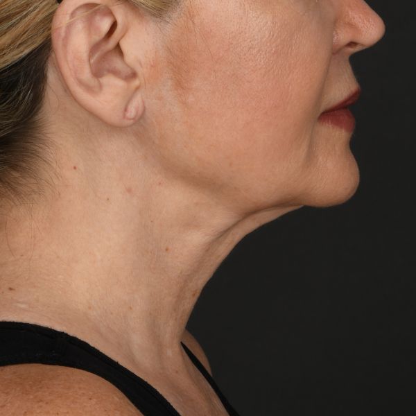 Neck Lift Before & After Image