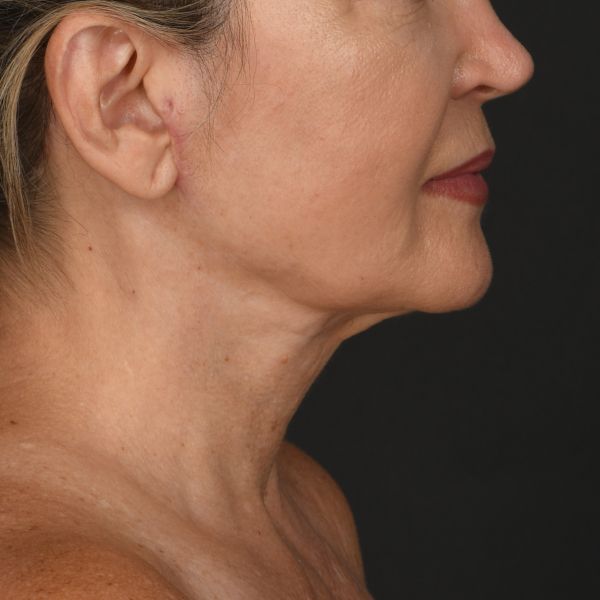Neck Lift Before & After Image